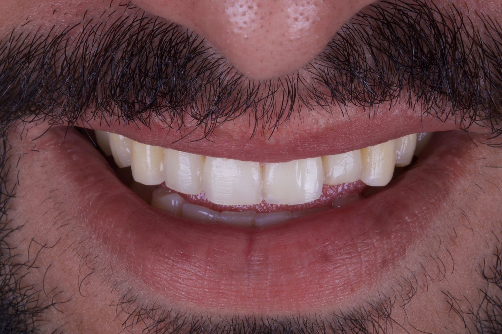 Facetas de Porcelana — situação antes do tratamento