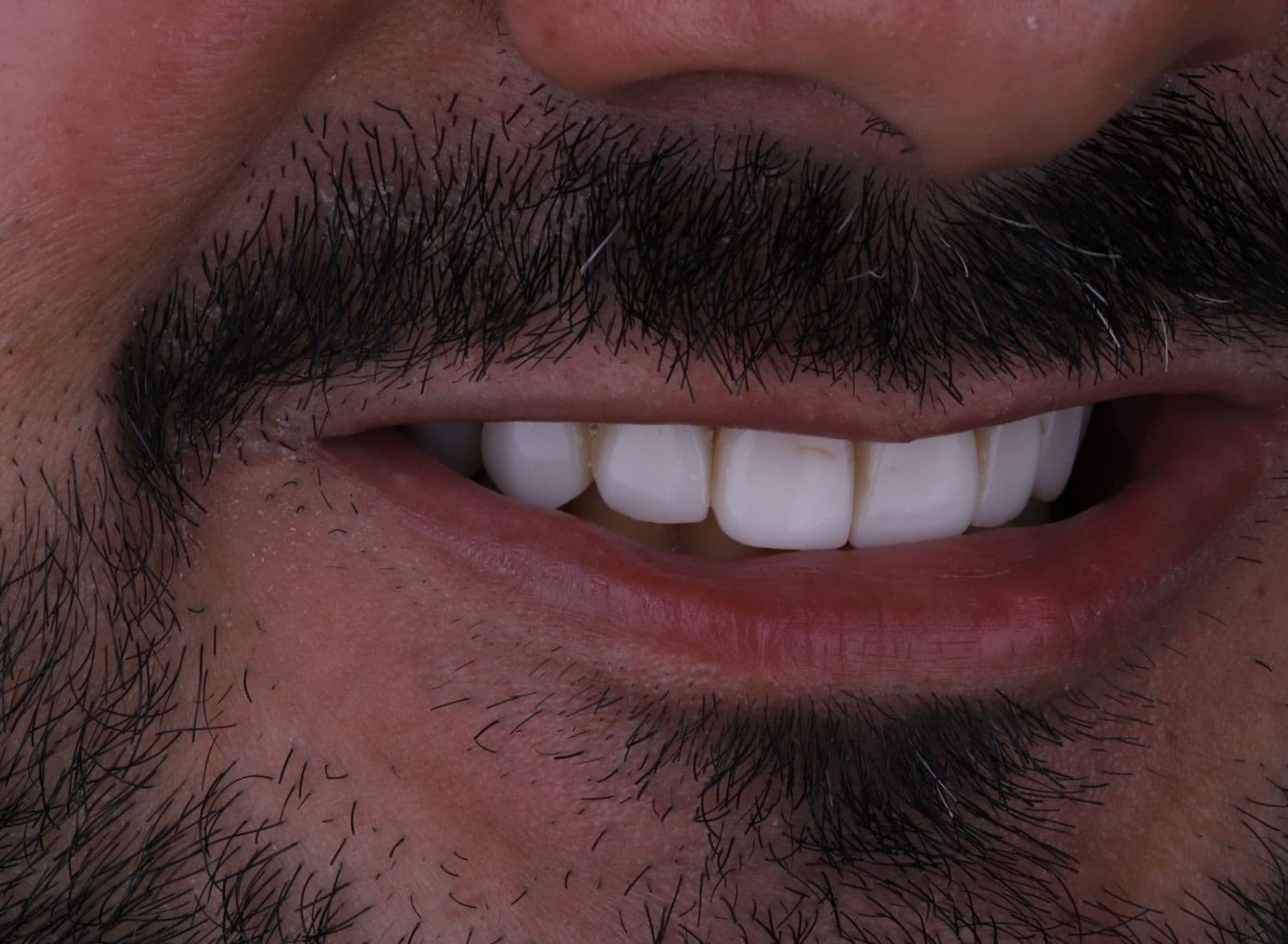 Lentes de Contato Dental — situação antes do tratamento