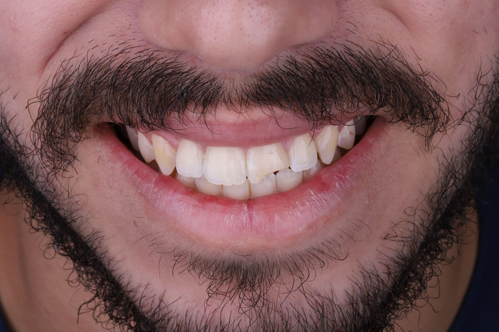 Design de Sorriso Digital — situação antes do tratamento