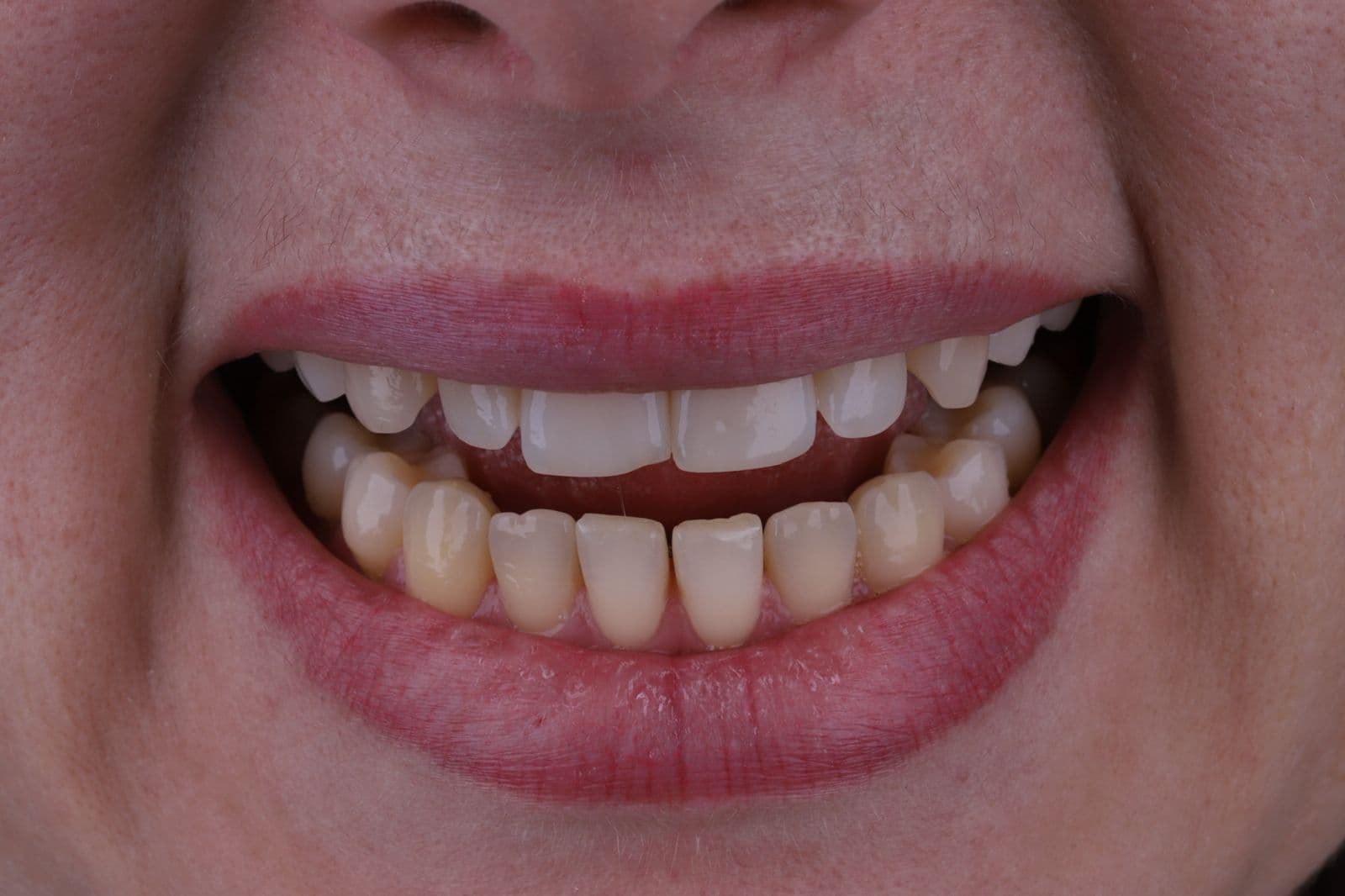 Harmonização do Sorriso — situação antes do tratamento