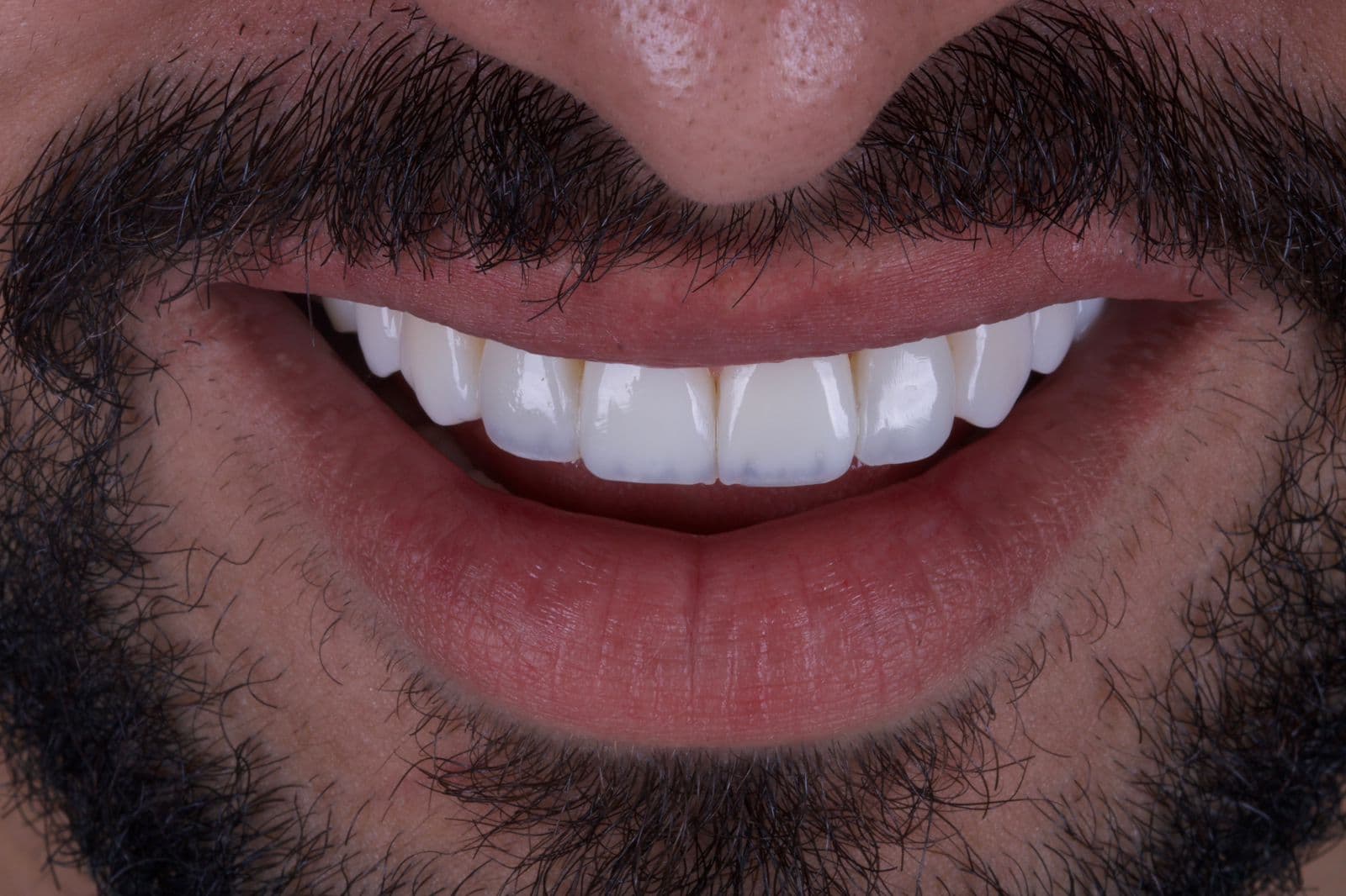 Facetas de Porcelana — resultado depois do tratamento