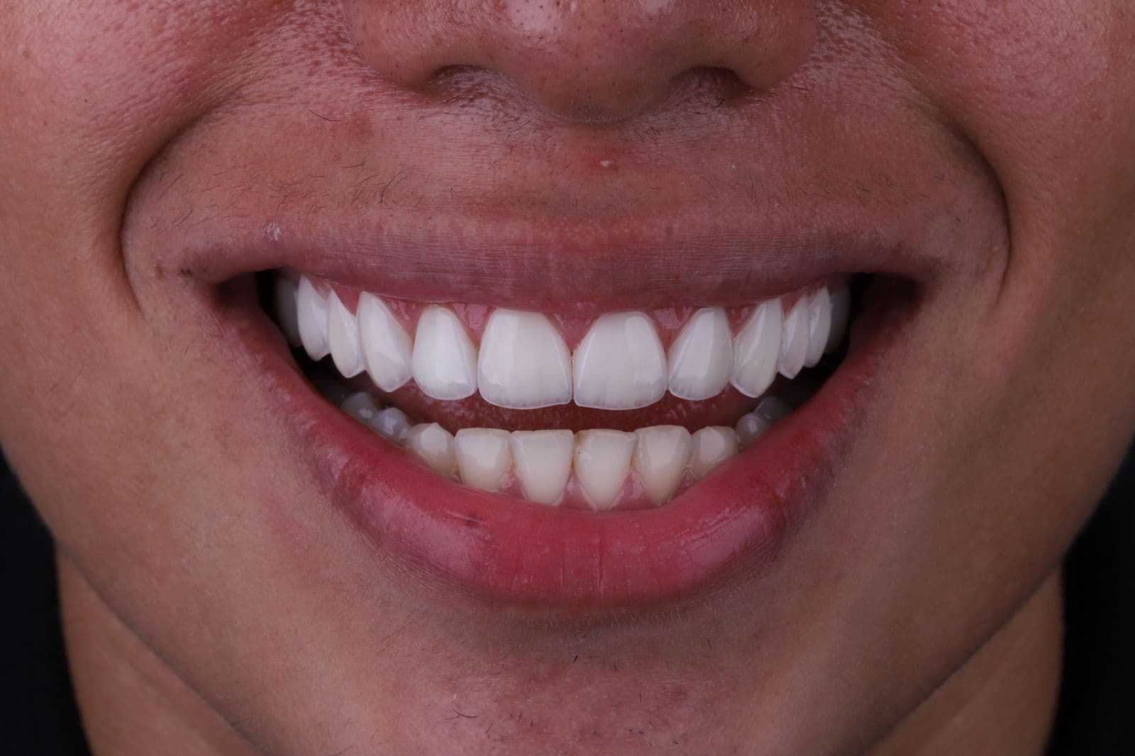 Harmonização do Sorriso